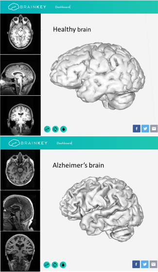 BrainKey Healthy vs Alzheimers brain3.png