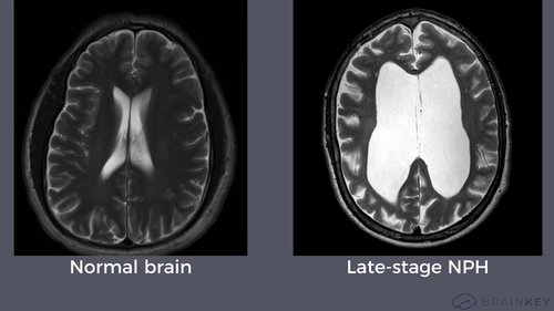 Normal and late stage brain - NPH .jpg