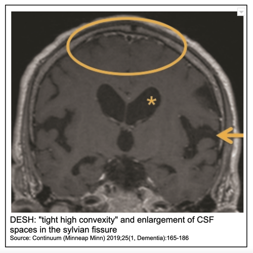 DESH: "tight high convexity" and enlargement of CSF spaces in the sylvian fissure Source: Continuum (Minneap Minn) 2019;25(1, Dementia):165-186