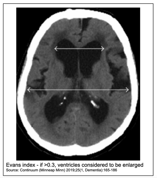 Evans index - if >0.3, ventricles considered to be enlarged Source: Continuum (Minneap Minn) 2019;25(1, Dementia):165-186