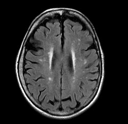 chronic-white-matter-microvascular-ischemic-disease.jpg